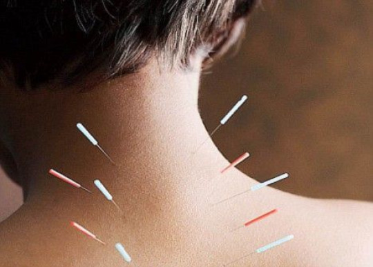 Dry Needle Therapy in Noida extension